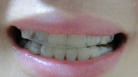 美白牙貼會反彈嗎？牙貼美白效果持續(xù)多久