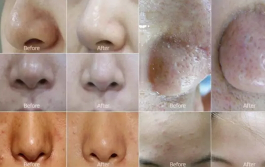 弄完小氣泡多久可以化妝？小氣泡注意事項(xiàng)