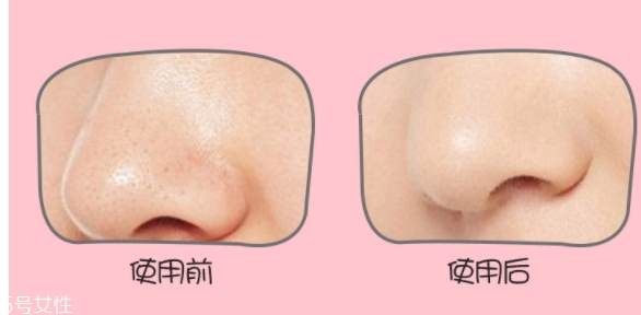 yoii黑頭儀怎么用？yoii黑頭儀怎么充電