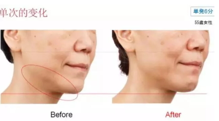 雅萌射頻美容儀防水嗎？雅萌Bloom射頻美容儀可以水洗嗎