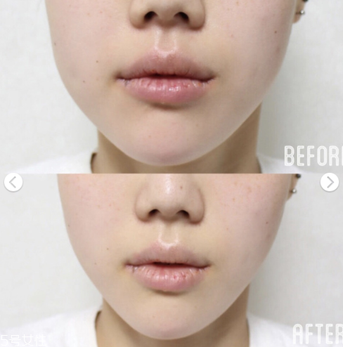 dodo label隱形瘦臉貼好用嗎 韓國(guó)ins網(wǎng)紅爆款瘦臉神器 dodo label隱形瘦臉貼好用嗎 韓國(guó)ins網(wǎng)紅爆款瘦臉神器