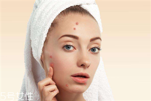 臉上為什么長痘 長痘痘的原因介紹 臉上為什么長痘 長痘痘的原因介紹