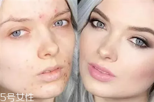 臉上長痘痘如何化妝 痘痘肌化妝的注意事項(xiàng)