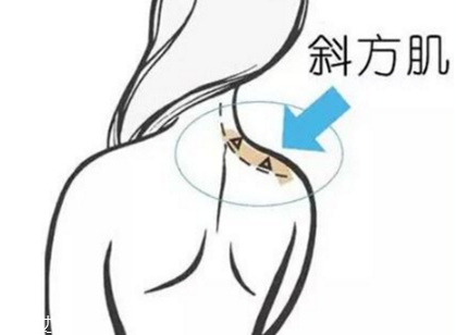 瘦肩針間隔多久打一次？打瘦肩針間隔時間