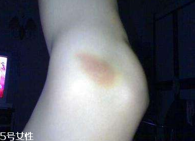 小林制藥去淤青膏怎么樣？小林制藥去淤青膏好用嗎？