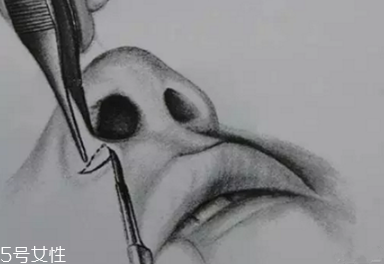 鼻翼外切多久消腫？鼻翼外切消腫時(shí)間要多長(zhǎng)？