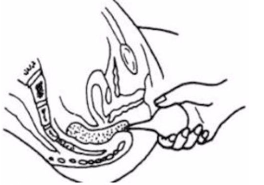 開塞露躺著還是蹲著用？開塞露使用姿勢