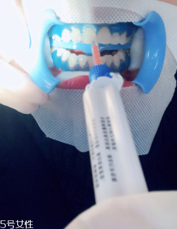 冷光美白會反彈嗎？冷光美白心得