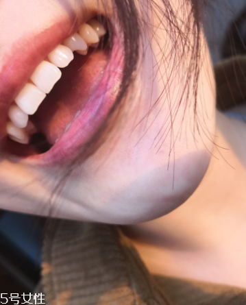 超聲波潔牙牙齒會變白嗎？超聲波潔牙心得