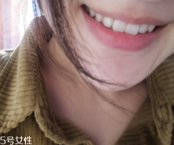 超聲波潔牙牙齒會變白嗎？超聲波潔牙心得