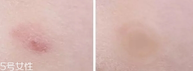 vt痘痘貼怎么用？vt老虎痘痘貼防水嗎