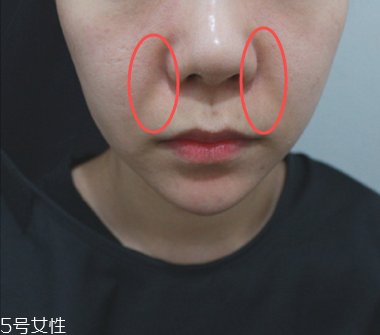 填充法令紋能維持多久 填充法令紋保持時間 填充法令紋能維持多久 填充法令紋保持時間