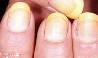 指甲變黃怎么調(diào)理 指甲變黃的治療方法 指甲變黃怎么調(diào)理 指甲變黃的治療方法