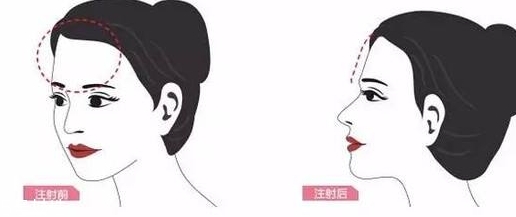 豐額頭多少錢 豐額頭要打多少針 豐額頭多少錢 豐額頭要打多少針