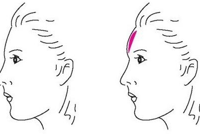 豐額頭多少錢 豐額頭要打多少針 豐額頭多少錢 豐額頭要打多少針