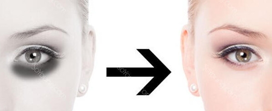 激光去黑眼圈多久恢復？激光除黑眼圈多久見效