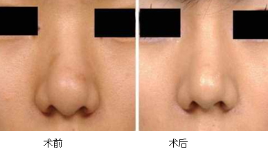 縮鼻手術(shù)多久恢復(fù)？縮鼻手術(shù)傷口才會好