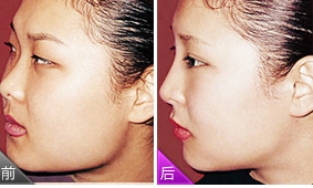 腫眼泡吸脂多少錢？腫眼泡吸脂做幾次