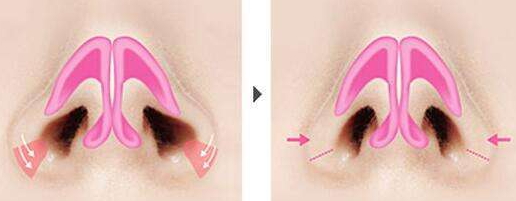 鼻孔縮小術(shù)后遺癥 鼻孔縮小術(shù)適合人群 鼻孔縮小術(shù)后遺癥 鼻孔縮小術(shù)適合人群