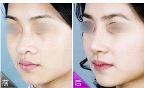 鼻孔縮小術(shù)后遺癥 鼻孔縮小術(shù)適合人群 鼻孔縮小術(shù)后遺癥 鼻孔縮小術(shù)適合人群