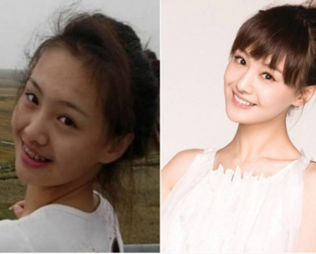 牙齒矯正會改變臉型嗎？矯正牙齒臉型變化圖