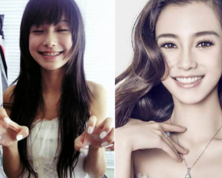 牙齒矯正會改變臉型嗎？矯正牙齒臉型變化圖