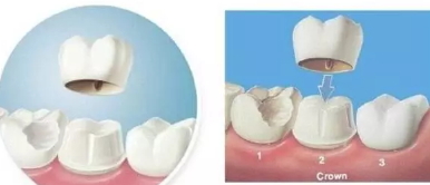 美容冠多少錢一顆？美容冠矯正費用