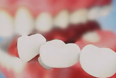 美容冠多少錢一顆？美容冠矯正費用