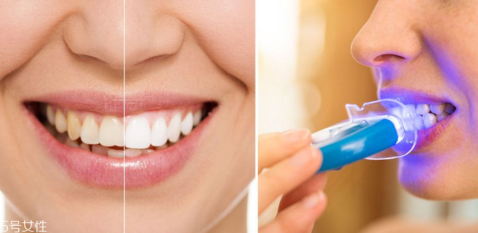 牙齒美白能保持多久？牙齒美白方法有哪些？