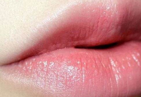 厚唇變薄術會反彈嗎？厚唇變薄術的真實經(jīng)歷