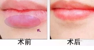 厚唇變薄術(shù)注意事項(xiàng) 厚唇變薄術(shù)術(shù)后護(hù)理 厚唇變薄術(shù)注意事項(xiàng) 厚唇變薄術(shù)術(shù)后護(hù)理