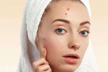 臉頰兩側(cè)長痘怎么治 臉頰兩側(cè)長痘的根治方法 臉頰兩側(cè)長痘怎么治 臉頰兩側(cè)長痘的根治方法