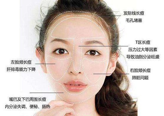臉頰兩側(cè)長痘怎么治 臉頰兩側(cè)長痘的根治方法 臉頰兩側(cè)長痘怎么治 臉頰兩側(cè)長痘的根治方法