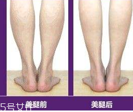 瘦小腿手術(shù)價(jià)格多少 瘦小腿手術(shù)很貴嗎 瘦小腿手術(shù)價(jià)格多少 瘦小腿手術(shù)很貴嗎