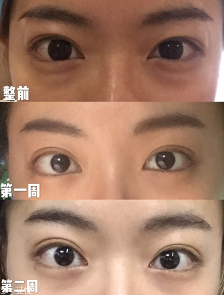 溶脂手術(shù)后多久能洗澡 溶脂手術(shù)后能用熱水洗澡嗎 溶脂手術(shù)后多久能洗澡 溶脂手術(shù)后能用熱水洗澡嗎