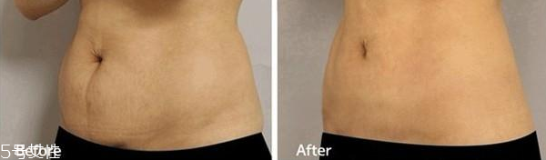 溶脂手術(shù)后多久能洗澡 溶脂手術(shù)后能用熱水洗澡嗎 溶脂手術(shù)后多久能洗澡 溶脂手術(shù)后能用熱水洗澡嗎