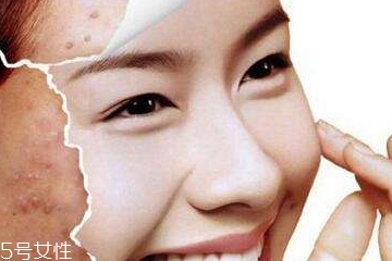 祛痘手術(shù)有哪些 4種祛痘手術(shù)哪種最好 祛痘手術(shù)有哪些 4種祛痘手術(shù)哪種最好