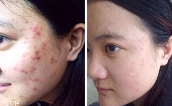 祛痘手術(shù)有哪些 4種祛痘手術(shù)哪種最好 祛痘手術(shù)有哪些 4種祛痘手術(shù)哪種最好