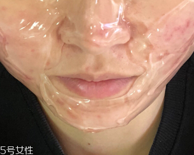 紅藍光治痤瘡需要幾次 紅藍光治痤瘡幾個療程能痊愈 紅藍光治痤瘡需要幾次 紅藍光治痤瘡幾個療程能痊愈