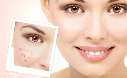 紅藍光治痤瘡需要幾次 紅藍光治痤瘡幾個療程能痊愈 紅藍光治痤瘡需要幾次 紅藍光治痤瘡幾個療程能痊愈