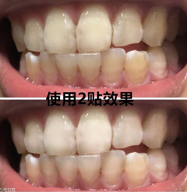佳潔士美白牙貼貼多久有效？佳潔士美白牙貼使用感受
