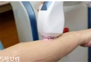 激光脫毛危險嗎 激光脫毛后注意事項