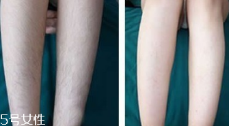 激光脫毛危險嗎 激光脫毛后注意事項