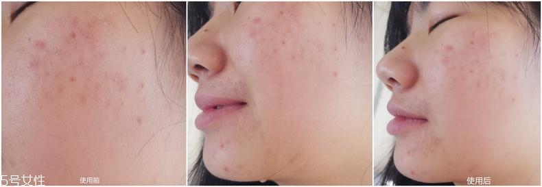 bio-e酵母精華有效嗎 1個月使用效果 bio-e酵母精華有效嗎 1個月使用效果