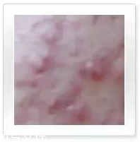 平衡露什么成分能祛痘 強效抑制痘痘生長 平衡露什么成分能祛痘 強效抑制痘痘生長