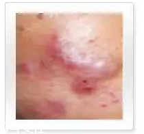 平衡露什么成分能祛痘 強效抑制痘痘生長 平衡露什么成分能祛痘 強效抑制痘痘生長