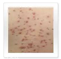 平衡露什么成分能祛痘 強效抑制痘痘生長 平衡露什么成分能祛痘 強效抑制痘痘生長