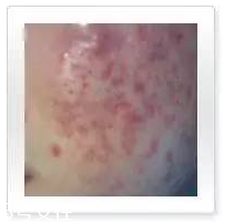 平衡露什么成分能祛痘 強效抑制痘痘生長 平衡露什么成分能祛痘 強效抑制痘痘生長