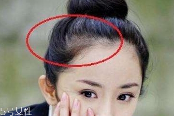 發(fā)際線低可以脫毛嗎 可以有效改善 發(fā)際線低可以脫毛嗎 可以有效改善