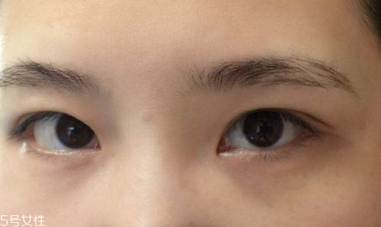 紋眉需要打麻藥嗎 沒這個必要